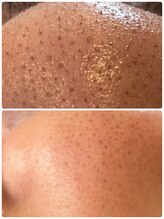 ママナ(mamana)/鼻の毛や口周り　光脱毛&WAX撃退