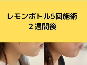 フェリス(feliz)/レモンボトル[小顔/美白/白石区]