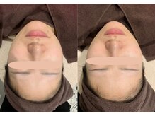 シャトン ボーテ(chaton beaute)/レモンボトルビフォーアフター☆