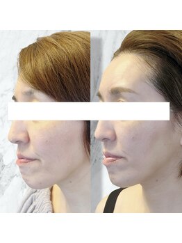 ルミライ(Lumirai)/たるみ改善|毛穴|フェイシャル