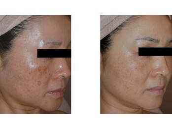 Nビューティー/セルフシミケアプログラム