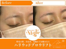 まいれ鍼灸院整骨院 整体院 草津院/ハリウッドブロウリフト/美眉