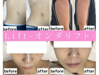 リフト 柏(Lift)/オンダリフト/Before/After