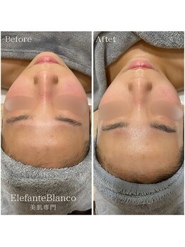 エレファンテブランコ(Elefante Blanco)/☆頬の赤み