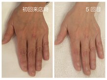 キレイテ 上野店/50代/5回目【ハンドケア上野】