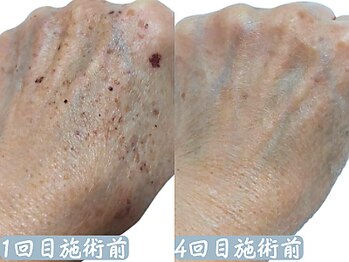 クレアナ ザ ビューティー(KULEANA the beauty)/手のシミケア