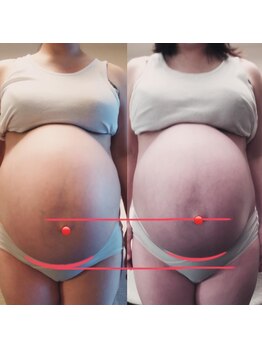 エッセンスマム 東京 プレナタールサロン(Prenatal salon)/お腹一回り小さく肋骨の痛みなく