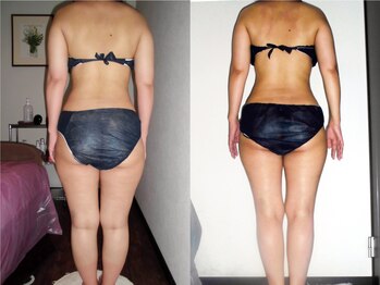 プリオール 高崎花水木店(Prior)/セルマジック痩身/全身痩身