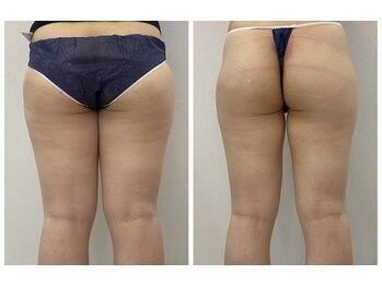 レミュ(Remu)/内股にも効果バツグン