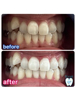 キラット 札幌中島公園店(Kiratt)/30代男性様初回before→after