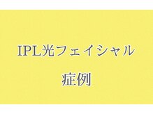 レゴリス/IPL光フェイシャル