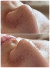 リノ(Lino)/フェイシャルワックスで産毛除去