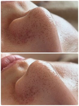 リノ(Lino)/フェイシャルワックスで産毛除去