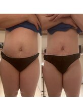 リハーツ(RE;heartz)/★－４℃脂肪冷却★大人気【腹】