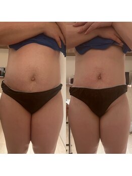 リハーツ(RE;heartz)/★－４℃脂肪冷却★大人気【腹】