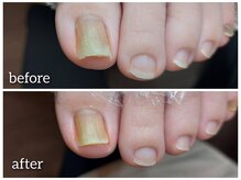 爪切り屋 足楽/【お悩み】爪の変色と巻き爪