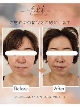 エクラヴィ(Eclatvie)/40代★施術事例