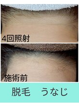 エミナル(EMINAL)/うなじ脱毛の効果！脱毛/うなじ/