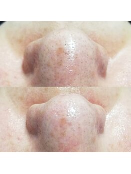 RiとBiのたまご/（フェイシャル）１回