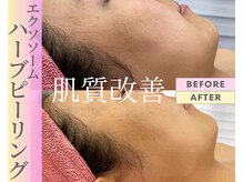 Cスキンケアクリニック 麻布店/ハーブピーリングBeforeAfter