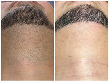 フェリス(FELIZ)/出来るだけ少ない回数で叶えたい