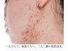 大人のニキビケアコース【本気で改善したい方】ニキビ/跡/肌荒れ/赤み/凹凸