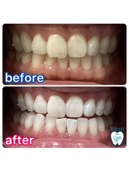 キラット 札幌中島公園店(Kiratt)/30代女性様初回before→after