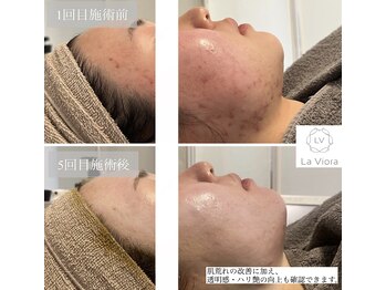 ラヴィオーラ 神戸三宮店(La Viora)/ダイヤモンドハーブピーリング