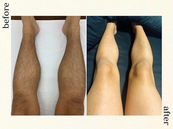 フォーマレイズ(Formalways)/【自慢のビフォアフ】