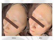 アン ビューティー(ann beauty)/施術1回【症例写真】30代