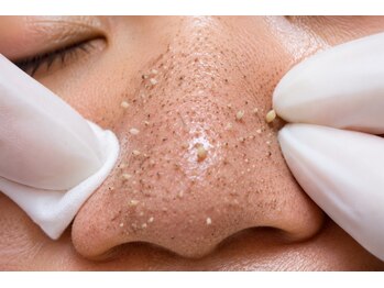 メイクアップスタジオ ウィッシュ(Make up Studio Wish!)の写真/毛穴の黒ずみ/開き/ニキビケアもお任せ!詰まった角栓は押さなきゃ取れない!深部の汚れを綺麗に除去♪