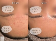 サロン ド エス アオヤマ(SALON DE S AOYAMA)の雰囲気（ララピール/LDM水玉リフティングでニキビ対策フェイシャルエステ）