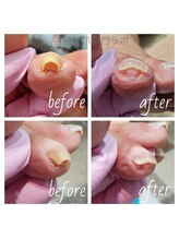 巻き爪専門ラボ 名古屋栄店/２趾　初回施術後