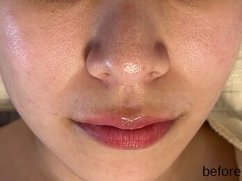 サロン ド エメ(salon de aimer)/【Before】赤み、開き毛穴に!