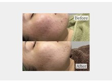 エステティック バイ マルキーズ(ESTHETIC by marquise)/20代・ハーブピーリング