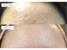 繰り返すニキビケアも♪正しいスキンケア方法をお伝えします。