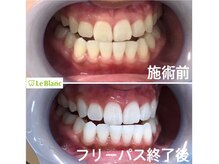 ルブラン 奈良店(Le Blanc)/口腔内清潔にしましょう！！