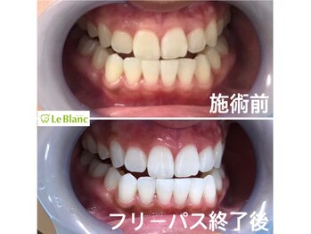 ルブラン 奈良店(Le Blanc)/口腔内清潔にしましょう！！