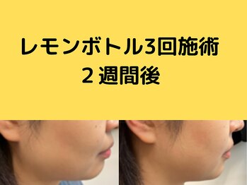 フェリス(feliz)/レモンボトル[小顔/美白/白石区]