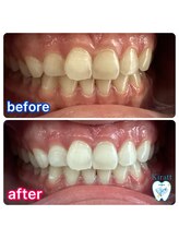 キラット 札幌中島公園店(Kiratt)/20代女性様初回before→after