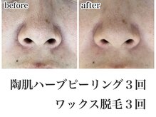 リミー 東大宮店(REME)/【ハーブ×WAX】鼻の黒ずみ緩和