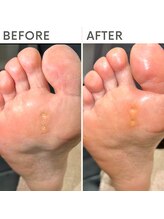 クオッカ(Quokka)/魚の目ケア