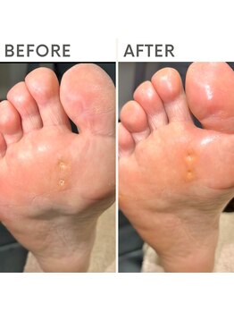 クオッカ(Quokka)/魚の目ケア