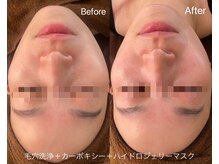 リアン(Lien)/毛穴洗浄＋カーボキシー＋マスク