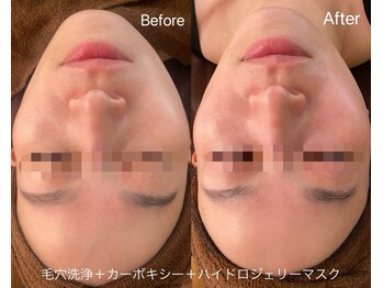 リアン(Lien)/毛穴洗浄＋カーボキシー＋マスク