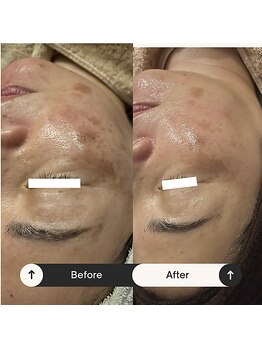 リマイン(Re mine)/濃いシミにもアプローチ