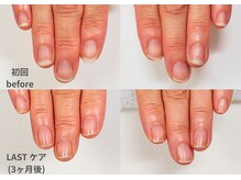 ナユネイル(na_yu.nail)/【地爪育成 症例１】