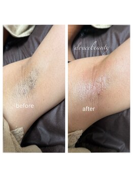 【光脱毛/WAX脱毛】doucek beauty/ワキ ワックス+光脱毛