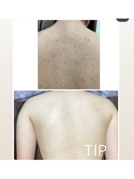 ビーピー 渋谷(b.p.)/背中ニキビケア