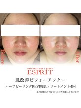 エスプリ 新宿店/毛穴キレイ・ハーブピーリング